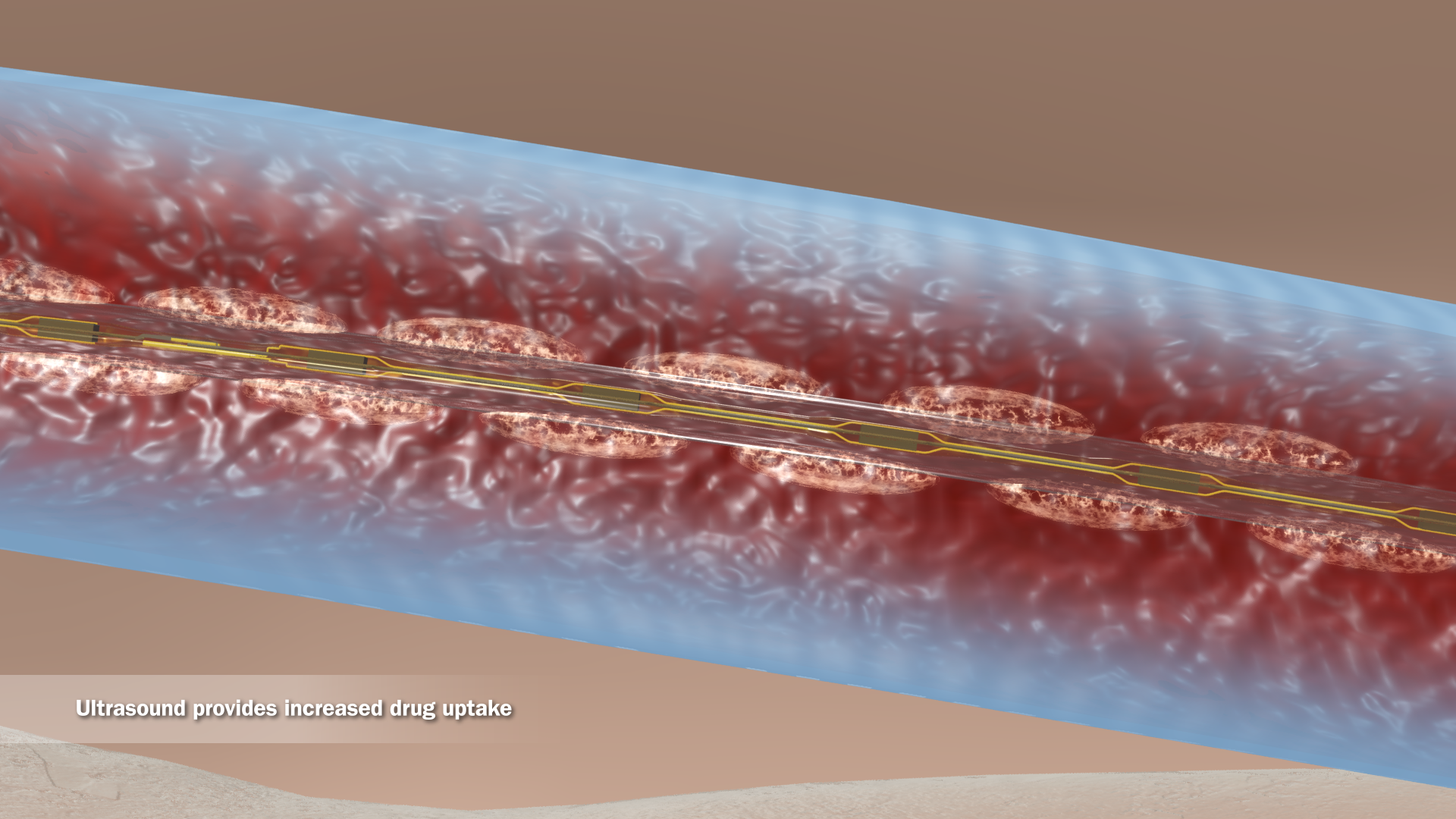 Ultrasoundassisted Catheterdirected Thrombolysis Reduces